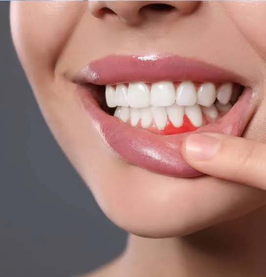 Laser Gum Treatment